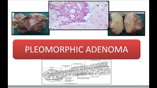 Pleomorphic Adenoma [upl. by Atilamrac]