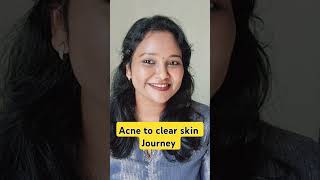 Acne to clear skin Journey 🔥acne acneproneskin skincare skincareroutine clearskin [upl. by Jochbed19]