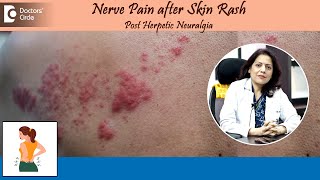 NERVE PAIN AFTER SKIN RASH Post Herpetic Neuralgia  Herpes ZosterDrSwati Bhat  Doctors Circle [upl. by Leckie371]