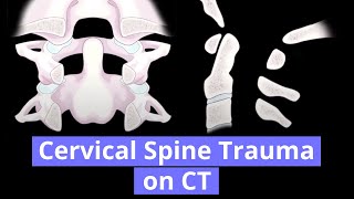 Cervical Spine Trauma on CT [upl. by Yelkao133]