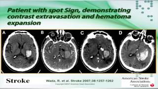 Intracerebral Hemorrhage by Sebastian Koch MD [upl. by Enialb]