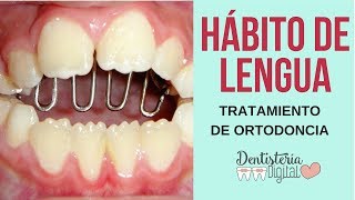 Hábito de Lengua y Tratamiento de Ortodoncia [upl. by Lucais75]