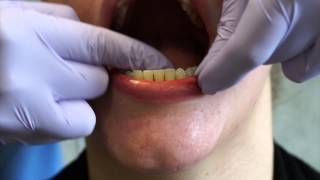 Flossing a Lower Fixed Retainer Lower Lingual Bar [upl. by Ttocs655]