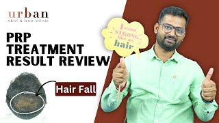 PRP Hair Loss treatment in Pune  Hair PRP Transformation Journey Real Patient Experience amp Results [upl. by Maurice]