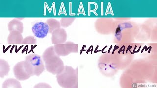 Malaria blood smear Plasmodium falciparum vs vivax headphone ring trophozoite banana gametocyte [upl. by Luttrell547]