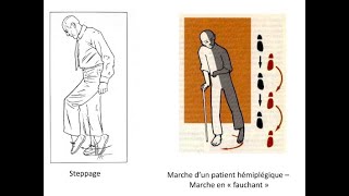 Fauchage et Steppage  Neurologie [upl. by Idaline]