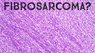 Fibrosarcoma amp Herringbone Pattern Explained in 5 Minutes pathology sarcoma dermpath [upl. by Larcher]