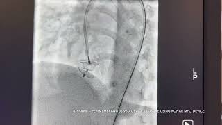 DRRAVIRT RETROGRADE PM VSD DEVICE CLOSURE [upl. by Pugh589]