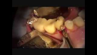 piezosurgery flapless complicated extraction of ankylosed root [upl. by Blainey]