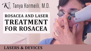 Rosacea and laser treatment for rosacea [upl. by Lasko818]