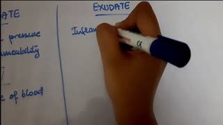 Pleural Effusion  EXUDATE vs TRANSUDATE  Lights criteria [upl. by Tower]