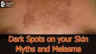 Dark Spots on your Skin  Hormones Vitamin D Melasma  Dr Aruna Prasad [upl. by Trocki]