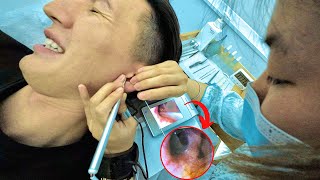 Intense Chinese Earwax Removal 🇨🇳 [upl. by Esilahs]