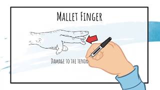 Mallet Finger Treatment EVERYTHING YOU NEED TO KNOW TO SELF TREAT [upl. by Titus]