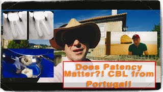 Retreatment Success Without Apical Patency CBL Vlog from Algarve Portugal [upl. by Onahpets571]