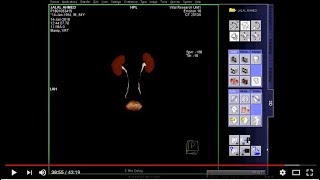 CT Urogram cutting amp full work process [upl. by Shaddock]