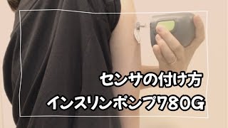 【インスリンポンプ】780G使用方法 CGMセンサ交換を腕バージョンで分かりやすく解説 [upl. by Haimaj]