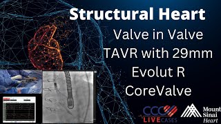 Valve in Valve TAVR with 29mm Evolut R CoreValve  January 8 2019 [upl. by Reerg568]