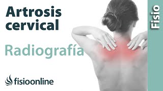 Artrosis cervical  Qué es y cómo se diagnostica en radiografías [upl. by Brunk]