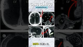 Hidrocefalia Caso Clínico 💀 radiologo casoclínico [upl. by Nonnel]