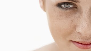 SEMPRE FELIZ – Conheça causas e tratamentos para o melasma [upl. by Aynahs]