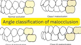 Molar classification of malocclusion SIMPLIFIED [upl. by Westley]