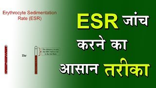 Blood Test Erythrocyte Sedimentation Rate ESR  By DPMI [upl. by Jemina32]