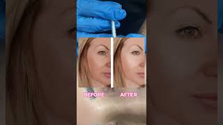 Botox For Eye Wrinkles  Botox Treatment in Banani  Gulshan  Dhaka  Aesthetic Skin Treatment [upl. by Nautna480]