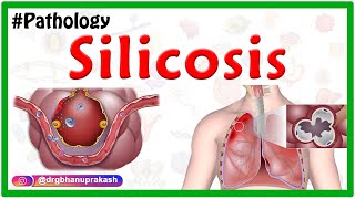 Silicosis Miners phthisis Grinders asthma  Etiology  Pathophysiology  Diagnosis Treatment [upl. by Nnorahs417]