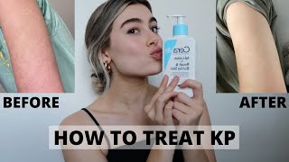 HOW TO GET RID OF KP ON ARMS  KERATOSIS PILARIS [upl. by Atinauj]