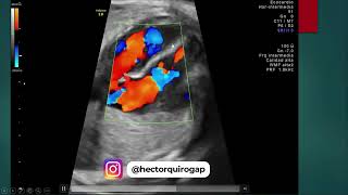 Ecocardiografía fetal Tips para evaluar el tabique interventricular [upl. by Lillis209]