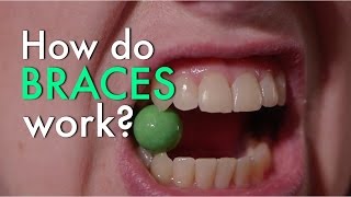 How Do Braces Work [upl. by Cook]