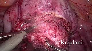 Prof Dr Alka Kriplani  laparoscopic adenomyomectomy [upl. by Sirraj]