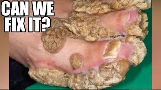 Palmoplantar Keratoderma PPK Worlds Thickest Feet [upl. by Arria]