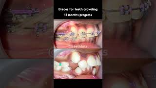 Crooked teeth Braces in 12 months progress braces orthodontics dental dentist teethbits [upl. by Enirehtac885]