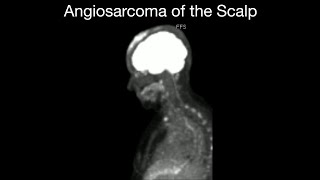 Angiosarcoma of the Scalp [upl. by Evangeline]