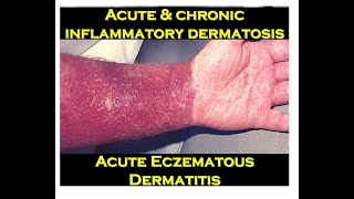 3b  Acute Eczematous Dermatitis [upl. by Urana]