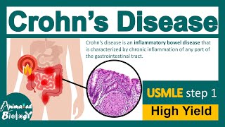 Crohns disease  What are the main cause of Crohns disease  Diagnosis and treatment  USMLE [upl. by Bremer]