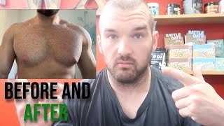 Gynecomastia Surgery Before and After 6 Weeks [upl. by Ayanej]