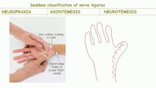 Seddons classification of nerve injurybackbenchers revolution [upl. by Sherie]