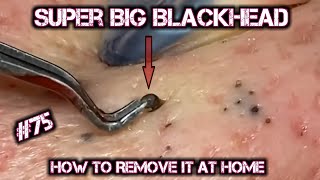 Satisfying Videos  Pimples Popping  Blackheads  Acne amp Cysts Compilation 75 [upl. by Sherwood946]