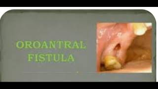 Oro antral fistula [upl. by Yadseut]