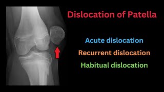 Dislocation of Patella Causes Types Pathology Clinical features Treatment amp Complications [upl. by Llennahc]