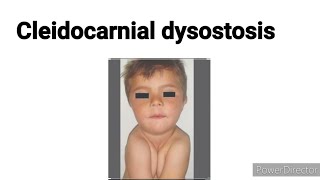 Cleidocranial dysostosis  Cleidocranial dysplasia  Basic concept building [upl. by Moria]