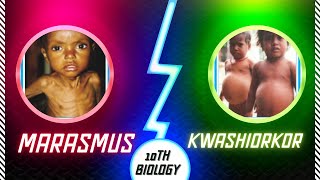 Marasmus and kwashiorkor nutritional deficiency diseases detailed explanation with pictures [upl. by Corsiglia600]