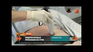 Как се махат стрии  Stretch marks striae removing treatment in Hill Clinic Sofia Bulgaria [upl. by Elayor]