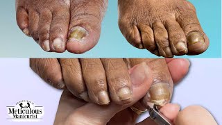 Watch this Clients Toenail Fungus Reversal Progression [upl. by Jurdi136]