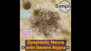 Severely Dysplastic Nevus Dermoscopy [upl. by Anawyt]