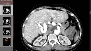 CT Angiography Case16 Hepatic splenic and SMA aneurysms [upl. by Lantha818]