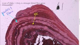 57P  Morphology of Thrombi and blood clots Review of heart blood flow path embolus [upl. by Marv]